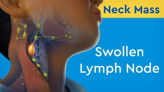 Swollen Lymph Nodes During Period