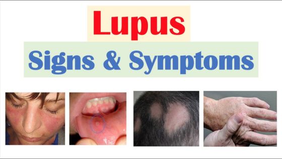 Can Lupus Affect Your Liver